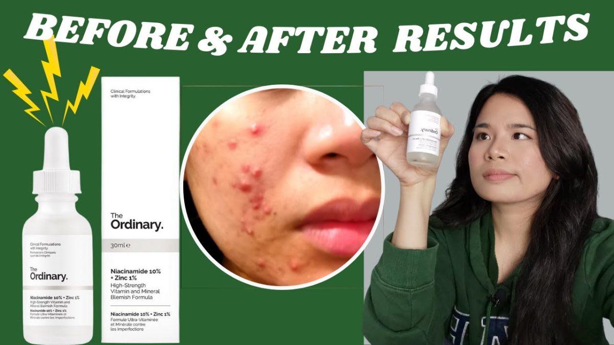 04 Ultimate Solution for Acne Marks - Daily Jugarr