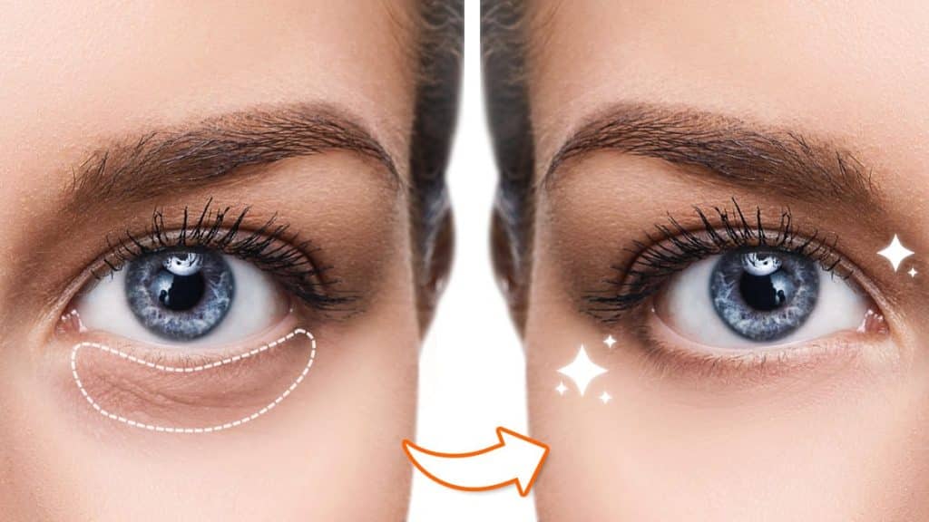 How To Remove Dark Circles Under Your Eyes Without Makeup Daily Jugarr