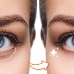 How To Remove Dark Circles Under Your Eyes Without Makeup