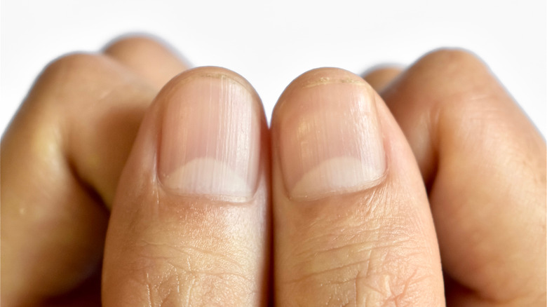 Understanding the Causes Behind Nail Ridges: What They Indicate About Your Health