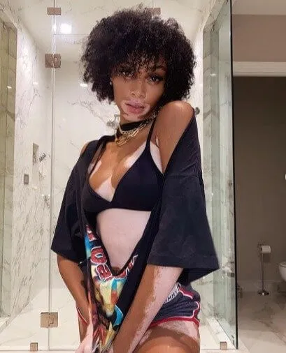 Winnie Harlow Went from Being Called a 'Zebra' to Becoming a Supermodel
